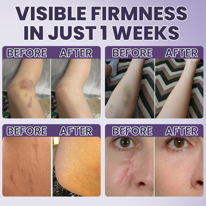💥100K+ SOLD🍷 𝐌𝐑𝐄𝐕𝐁𝑺𝑰𝑵® NEW Upgraded Bruise Repair Cream | Skin-Strengthening Formula for Easily Bruised Skin