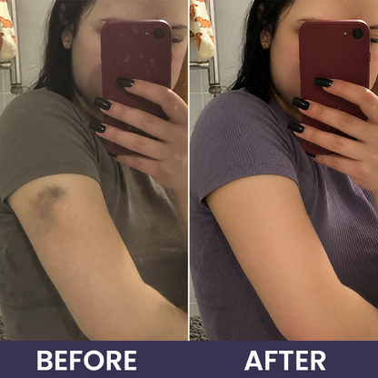 💥100K+ SOLD🍷 𝐌𝐑𝐄𝐕𝐁𝑺𝑰𝑵® NEW Upgraded Bruise Repair Cream | Skin-Strengthening Formula for Easily Bruised Skin