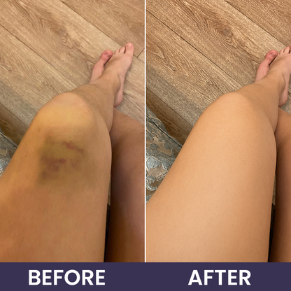 💥100K+ SOLD🍷 𝐌𝐑𝐄𝐕𝐁𝑺𝑰𝑵® NEW Upgraded Bruise Repair Cream | Skin-Strengthening Formula for Easily Bruised Skin