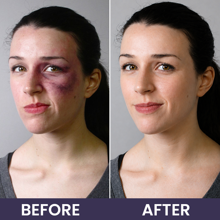 💥100K+ SOLD🍷 𝐌𝐑𝐄𝐕𝐁𝑺𝑰𝑵® NEW Upgraded Bruise Repair Cream | Skin-Strengthening Formula for Easily Bruised Skin