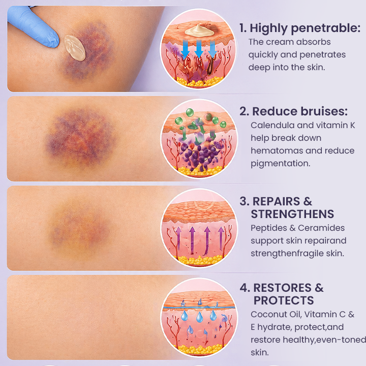 💥100K+ SOLD🍷 𝐌𝐑𝐄𝐕𝐁𝑺𝑰𝑵® NEW Upgraded Bruise Repair Cream | Skin-Strengthening Formula for Easily Bruised Skin
