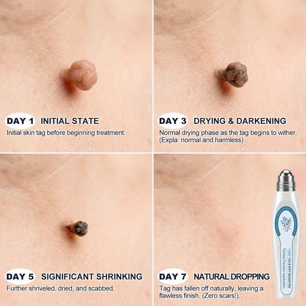 Official Store 🎉 Newly Upgraded 7-Day Tag & Spot Eraser Rollerball | Precision Care for Skin Tags, Dark Spots & Rough Bumps | Gentle Botanical Formula