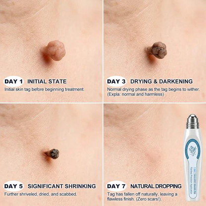Official Store 🎉 Newly Upgraded 7-Day Tag & Spot Eraser Rollerball | Precision Care for Skin Tags, Dark Spots & Rough Bumps | Gentle Botanical Formula